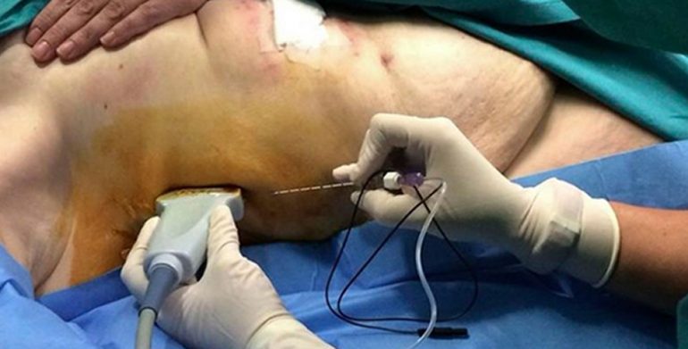 Brilma Modificado ¿Nuevo abordaje del dolor postoperatorio en cirugía abierta supraumbilical?