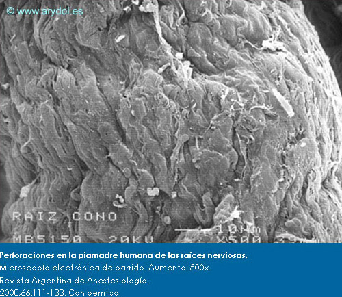 Perforaciones en la piamadre humana de las raíces nerviosas.Microscopía electrónica de barrido. Aumento: 500x. Revista Argentina de Anestesiología. 2008;66:111-133. Con permiso.